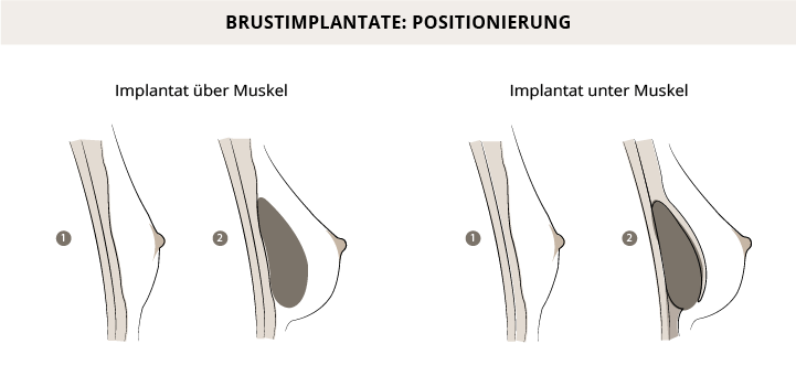 Positionierung Brustimplantate, Hannover, Dr. Entezami, Klinik am Pelikanplatz 