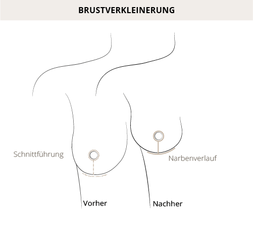 Brustverkleinerung, Hannover, Dr. Entezami, Klinik am Pelikanplatz 