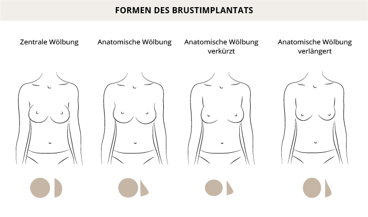 Formen Brustimplantate, Hannover, Dr. Entezami, Klinik am Pelikanplatz 
