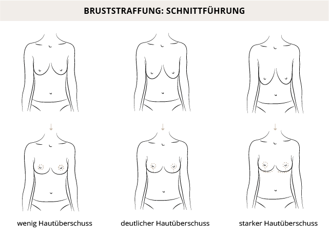 Schnittführung Bruststraffung, Hannover, Dr. Entezami, Klinik am Pelikanplatz 